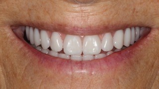 Fixed Rehabilitation on Dental Implants