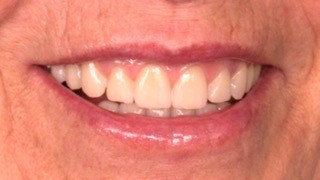 Prótese Fixa sobre Implantes Dentários