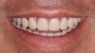 Prótese Total Fixa sobre Implantes Dentários
