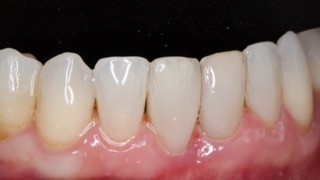 Composite Veneers and Teeth Whitening