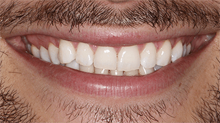 Branqueamento Dentário