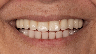 Fixed Prosthesis on Dental Implants