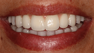 Prótese Total Fixa sobre Implantes Dentários