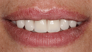 Dental Implants and Ceramic Fixed Prosthesis