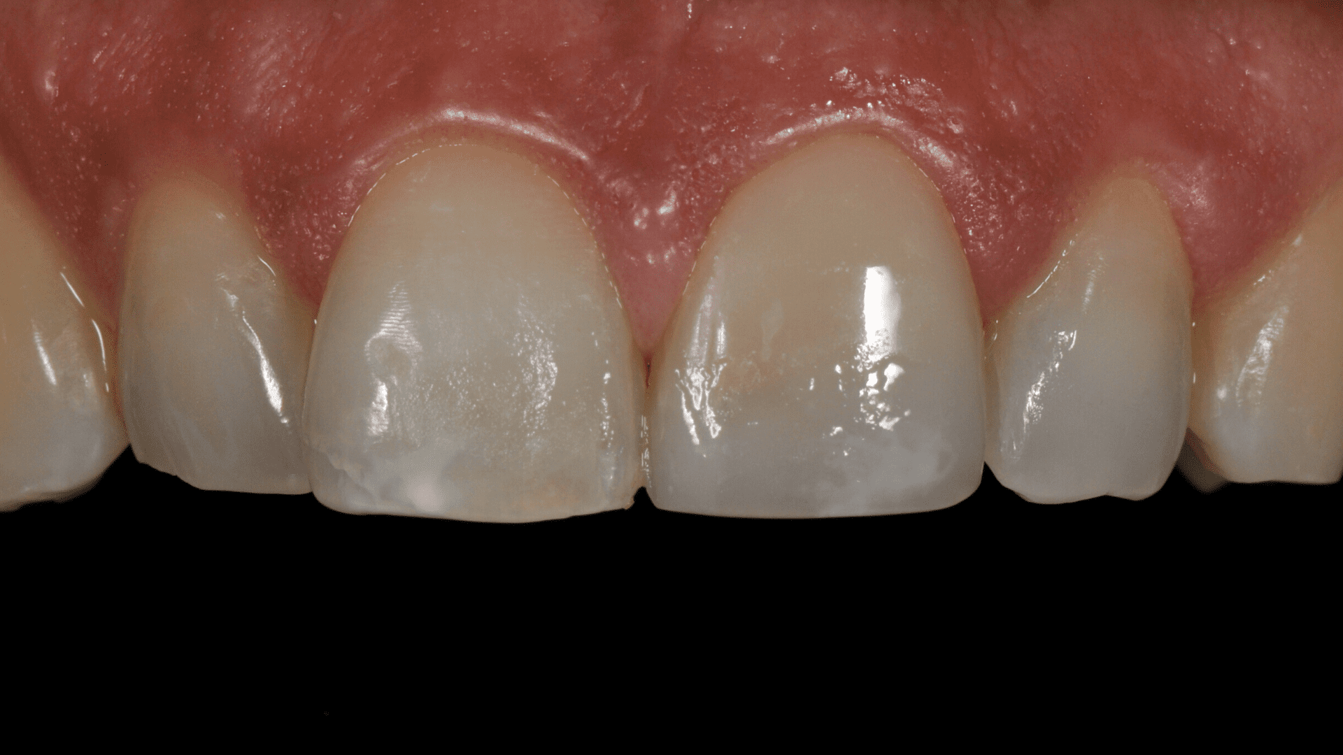 Direct Restoration in Composite Resin You Clínica Dentária
