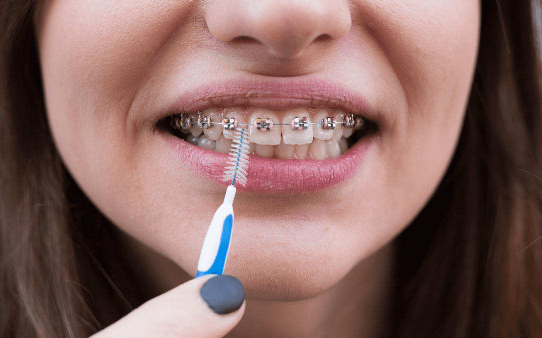 Aparelho Dentário Fixo: como fazer uma correta higiene oral?