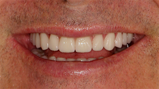 Dental Implants and Fixed Prosthesis