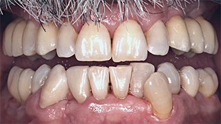 Implantes Unitários, Endodontia e Dentisteria