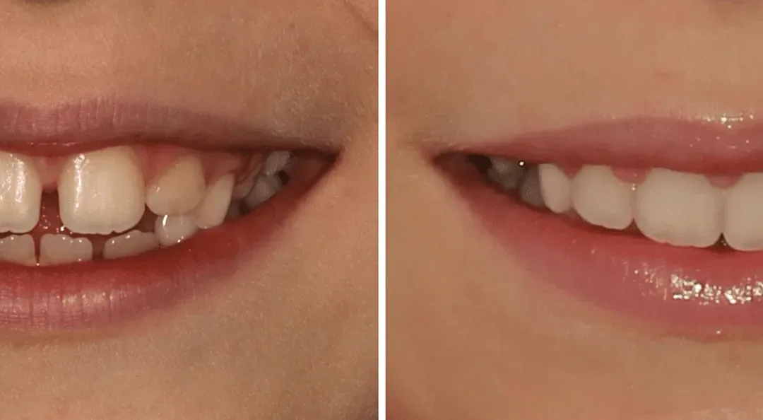 Caso Clínico — Aparelho de expansão fixo e aparelho parcial fixo