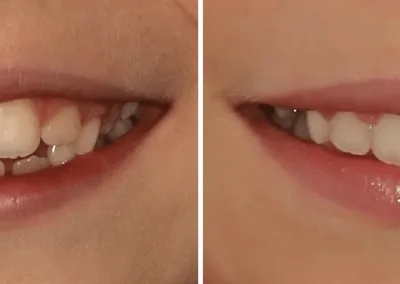 Caso Clínico — Aparelho de expansão fixo e aparelho parcial fixo