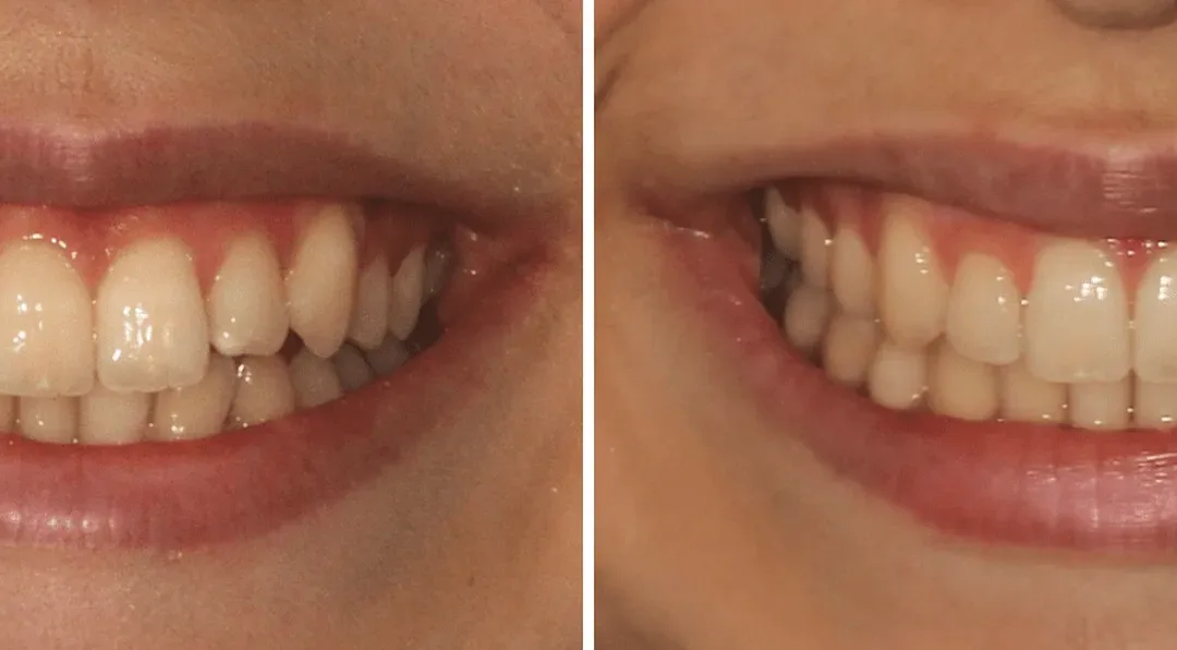 Caso Clínico — Alinhadores Invisalign®️