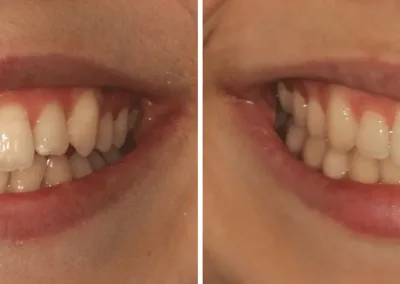 Caso Clínico — Alinhadores Invisalign®️