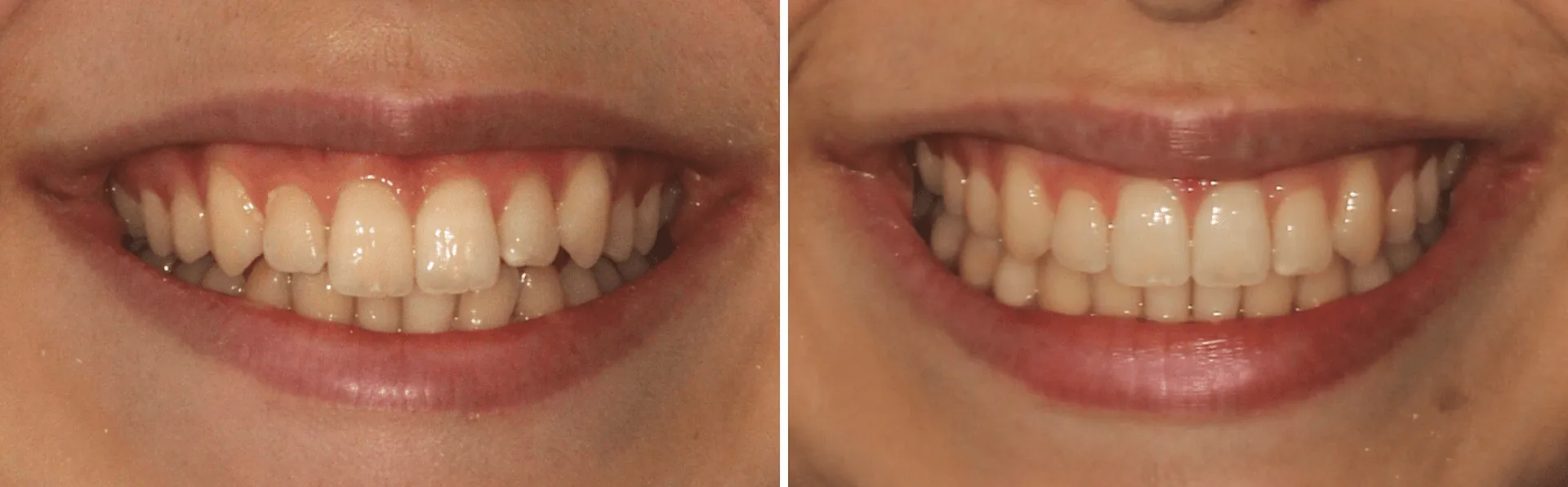 #6 alinhadores invisalign