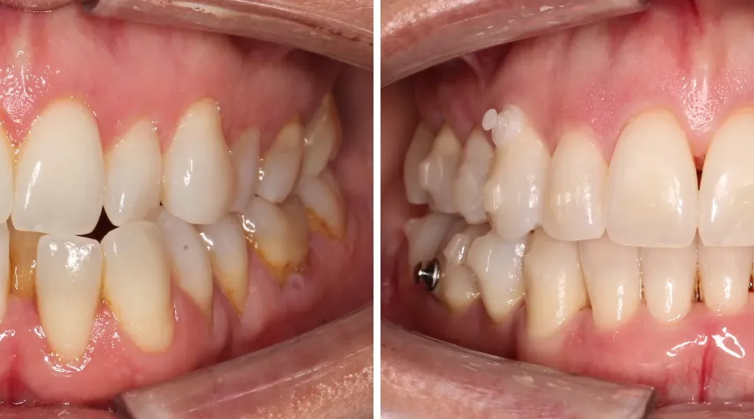 Caso Clínico — Aparelho invisível