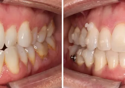 Caso Clínico — Aparelho invisível