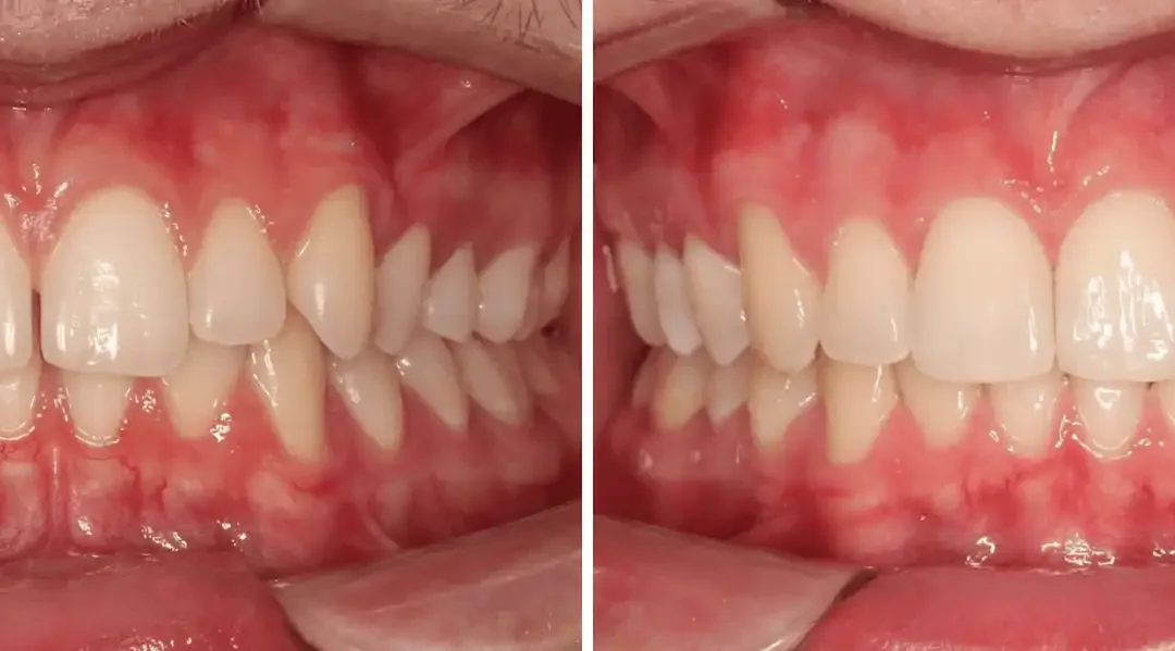 Caso Clínico — Alinhadores removíveis e invisíveis