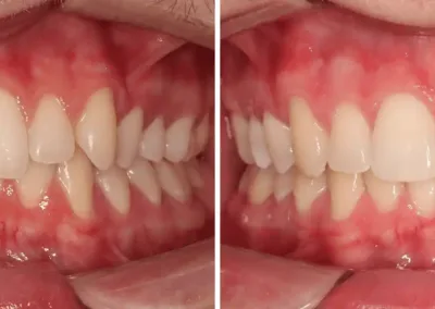 Caso Clínico — Alinhadores removíveis e invisíveis