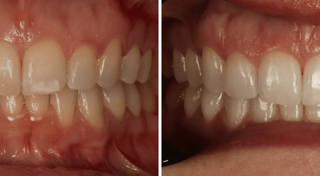 Caso Clínico — Branqueamento dentário