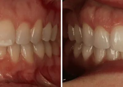 Caso Clínico — Branqueamento dentário