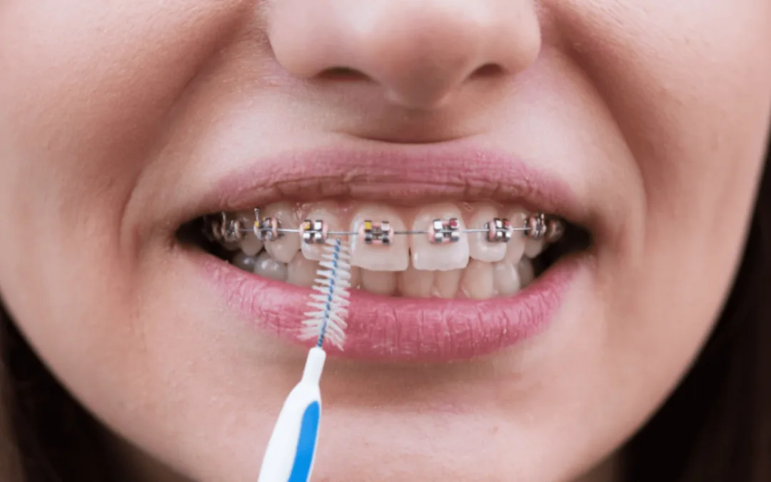 Aparelho Dentário Fixo: como fazer uma correta higiene oral?