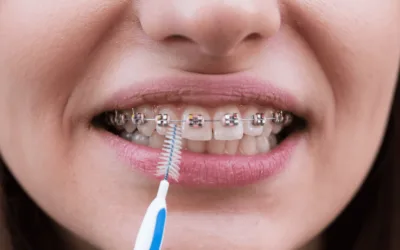 Aparelho Dentário Fixo: como fazer uma correta higiene oral?