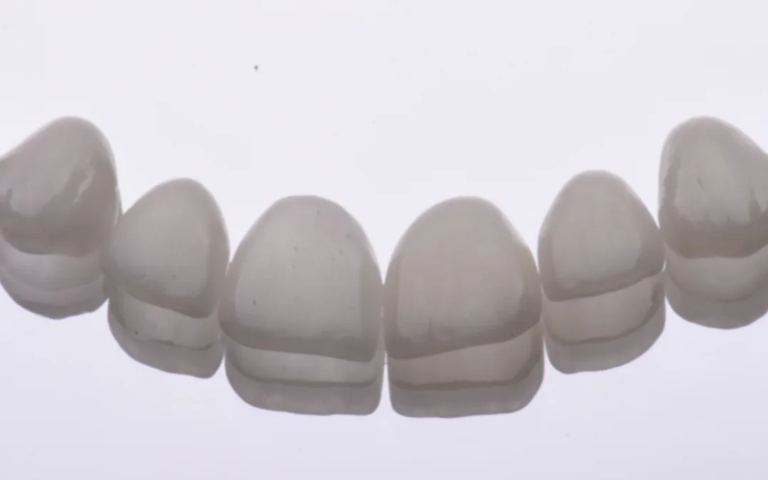 Facetas dentárias em cerâmica: o que são?