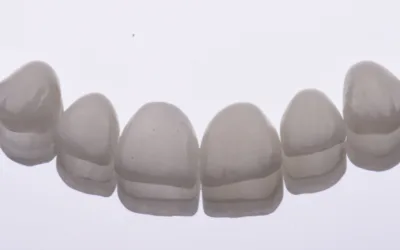 Facetas dentárias em cerâmica: o que são?