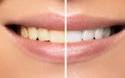 Como branquear os dentes: serão as pastas branqueadoras eficazes?