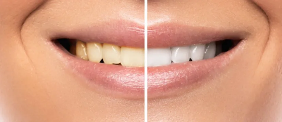 Como branquear os dentes: serão as pastas branqueadoras eficazes?