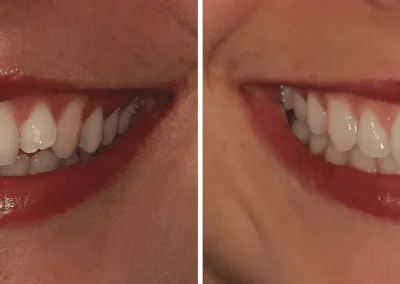 Caso Clínico — Alinhadores Spark®