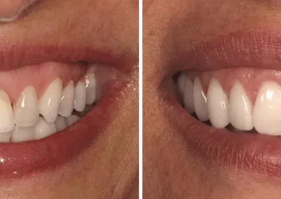 Caso Clínico — Harmonização Facial, Periodontologia, Implantologia e Dentisteria