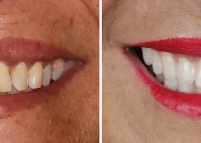 Caso Clínico — Cirurgia Oral, Endodontia, Dentisteria e Harmonização Facial