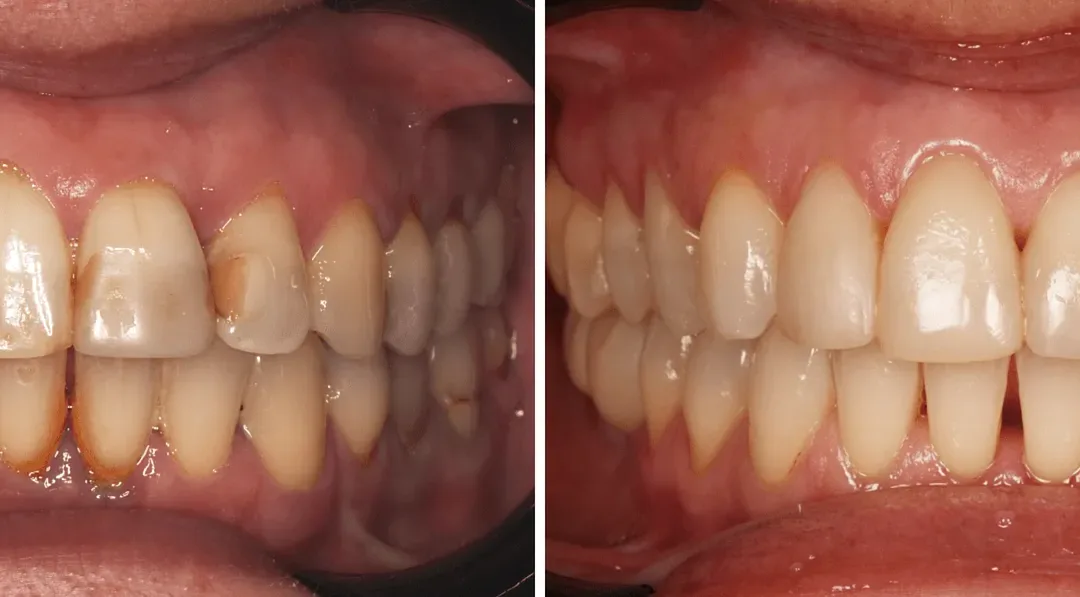 Caso Clínico — Restaurações Diretas e Branqueamento Dentário
