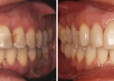 Caso Clínico — Restaurações Diretas e Branqueamento Dentário