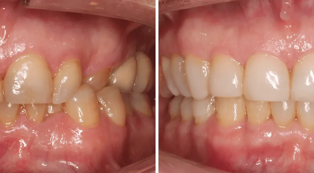 Caso Clínico — Ortodontia, Dentisteria e Implantologia