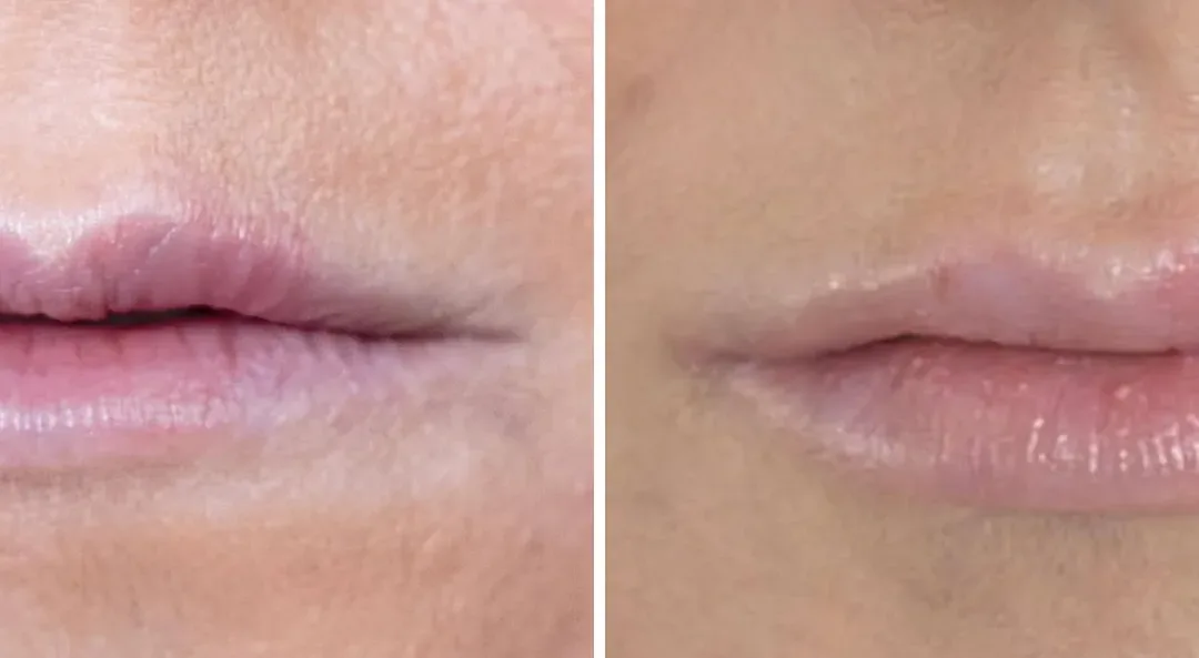 Caso Clínico — Preenchimento com Ácido Hialurónico