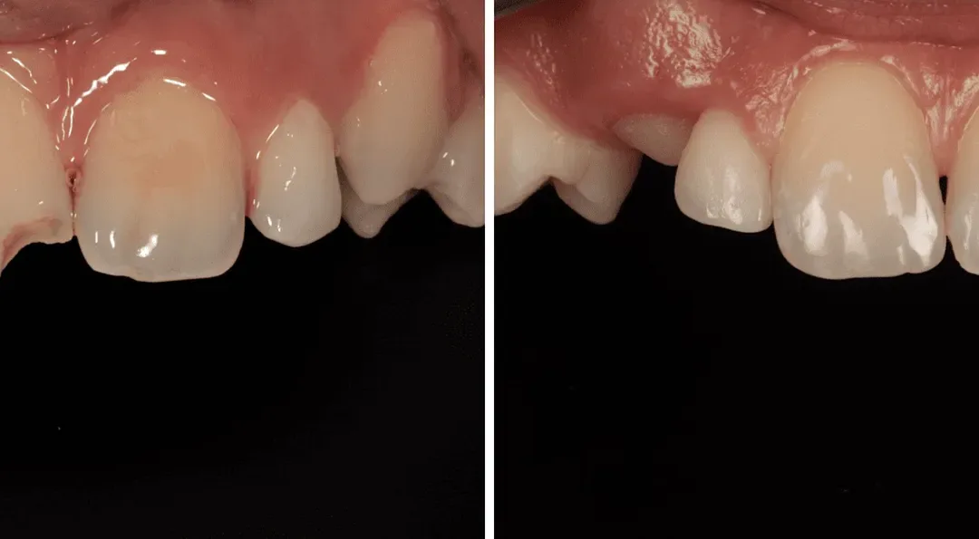 Caso Clínico — Restauração Direta em Resina Composta