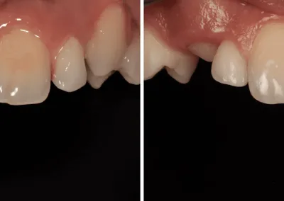 Caso Clínico — Restauração Direta em Resina Composta