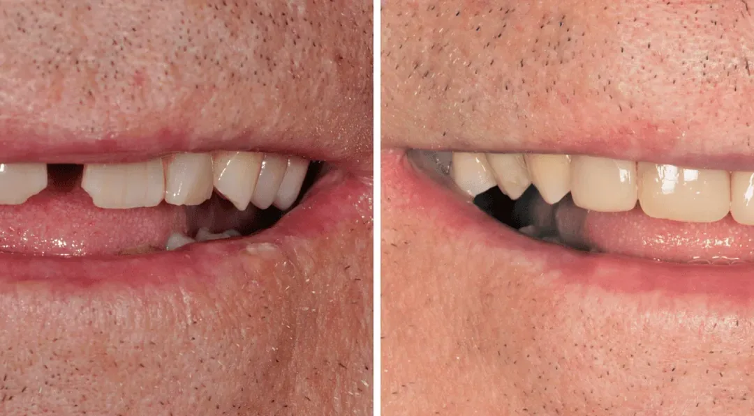 Caso Clínico — Restaurações Diretas