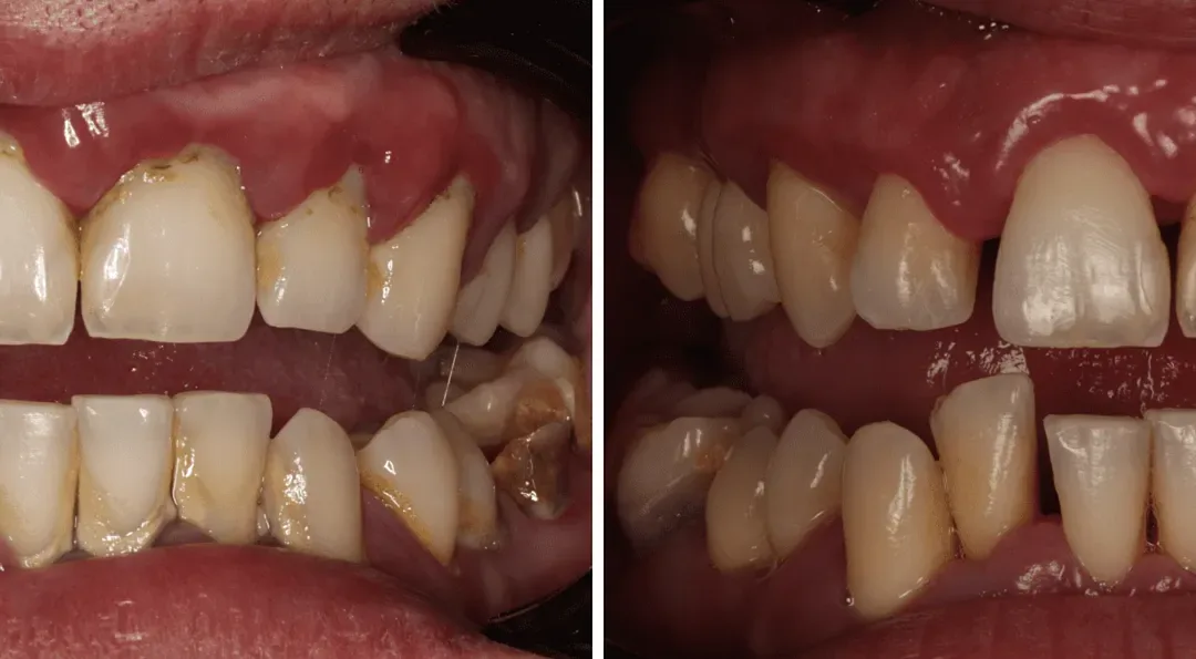 Caso Clínico — Guided Biofilm Therapy (GBT)