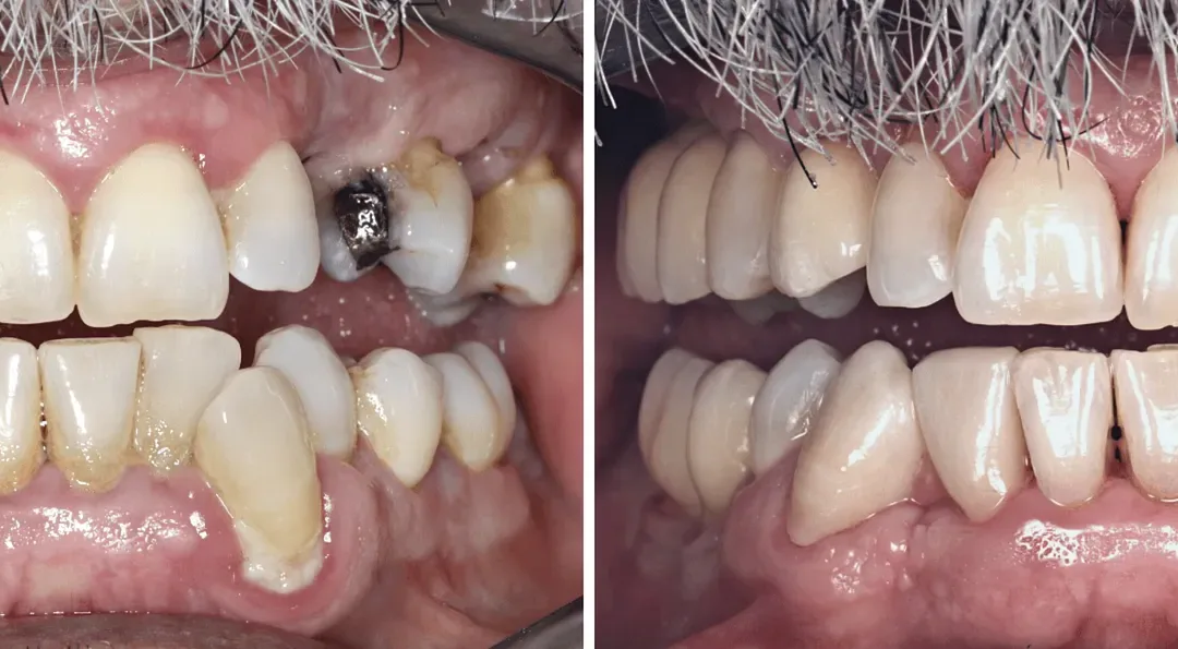 Caso Clínico — Implantes Unitários, Endodontia e Dentisteria