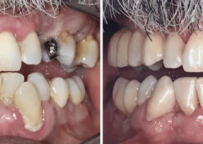 Caso Clínico — Implantes Unitários, Endodontia e Dentisteria