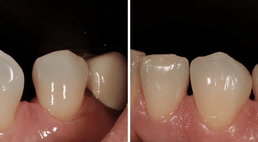 Caso Clínico — Restaurações Diretas