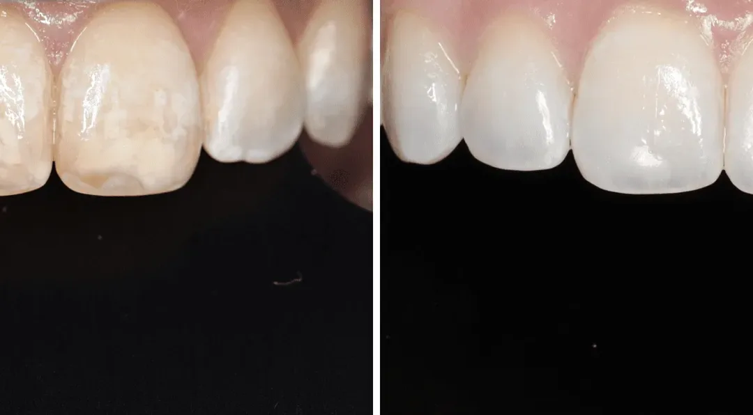 Caso Clínico — Icon DMG® System