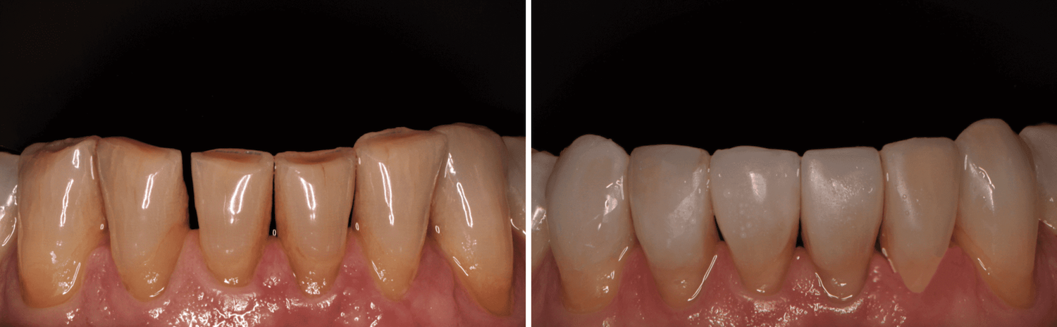 #21 Restauração Direta em Resina Composta