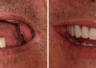 Caso Clínico — Implantes Dentários e Prótese Fixa