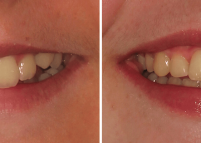 Caso Clínico — Aparelho de Expansão e Aparelho Fixo Bimaxilar