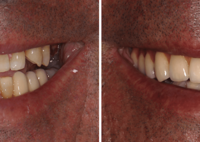 Caso Clínico — Implantes Dentários e Prótese Fixa em Cerâmica
