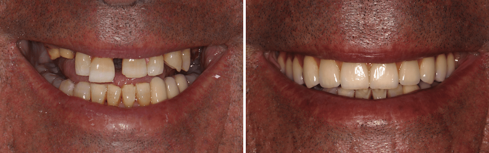 Caso Clínico — Implantes Dentários e Prótese Fixa em Cerâmica