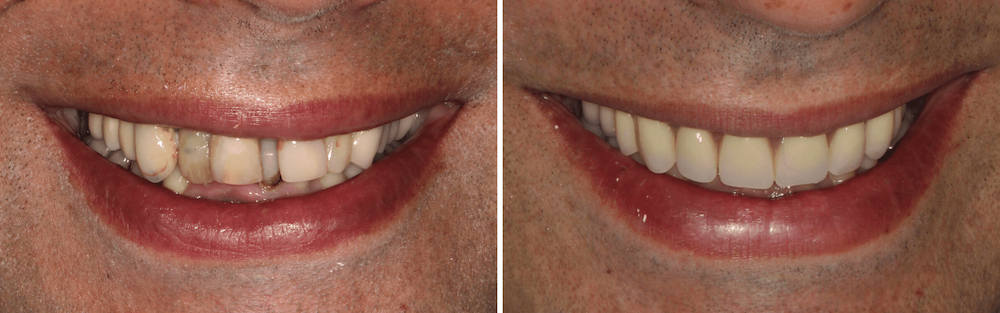 Caso Clínico — Implantes Dentários e Prótese Fixa em Cerâmica